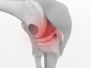 「膝の痛み」の原因